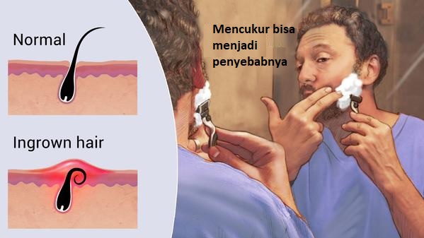 apa itu ingrown hair
